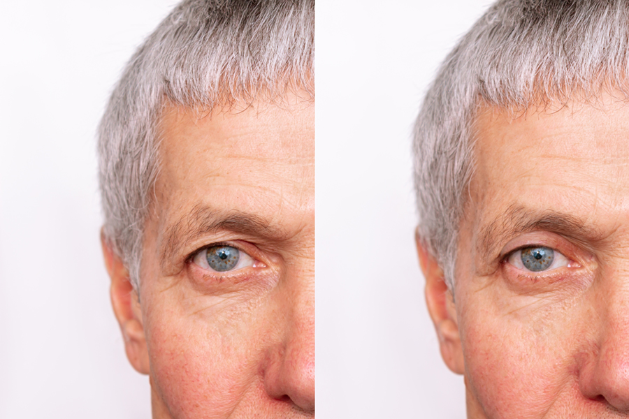 Cropped shot of a elderly caucasian man's face with drooping upper eyelid before and after blepharoplasty isolated on white background. Result of plastic surgery. 