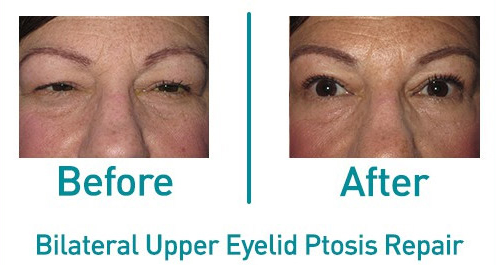 Bilateral Upper Eyelid Ptosis Before and After