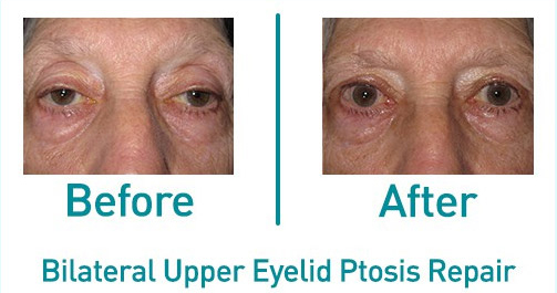 Bilateral Upper Ptosis