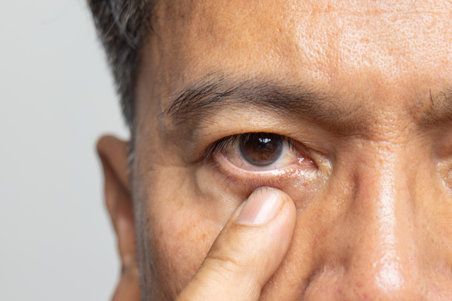 Man with blepharospasm