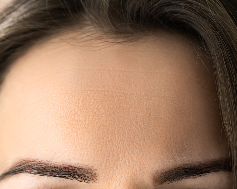 Anti Age Rejuvenation Forehead Lift