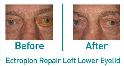 Ectropion repair lower left eyelid before and after