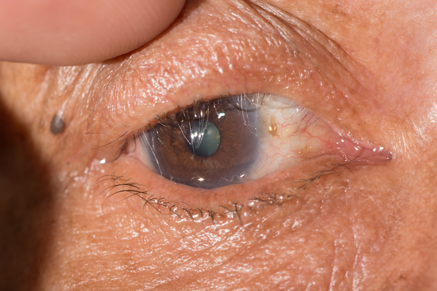 Close up of entropion during eye examination.