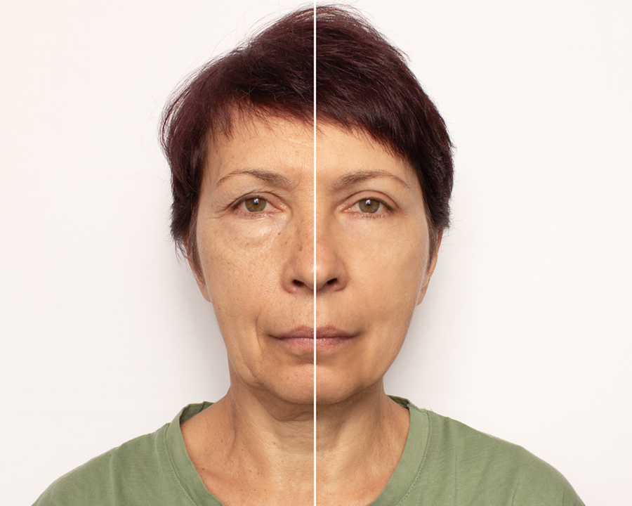 older woman before and after lower eyelid blepharoplasty