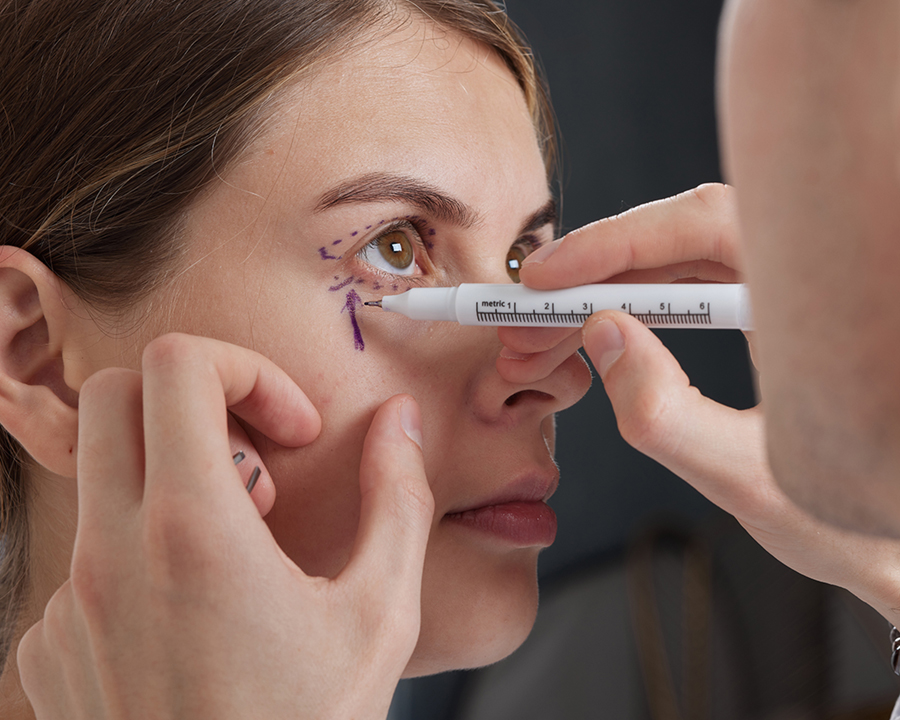 Woman having eyelids marked for blepharoplasty surgery