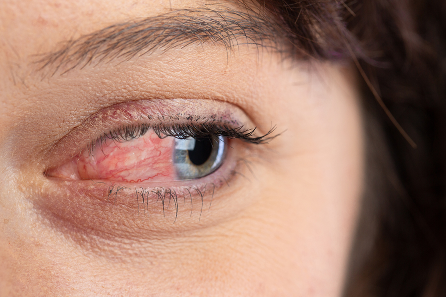 Close up of human eye of woman suffering with ocular rosacea