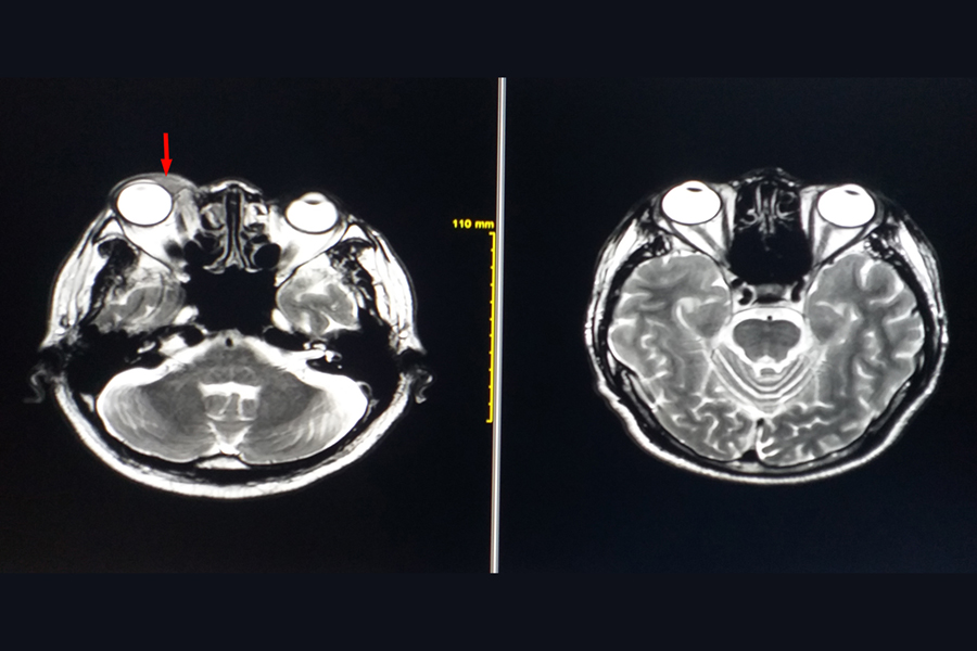 MRI Scans showing orbital tumors