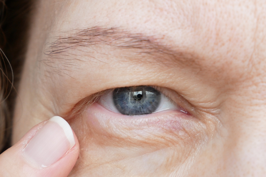 Ptosis is a drooping of the upper eyelid