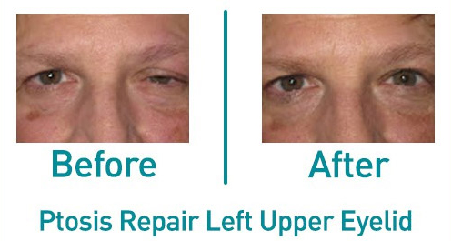 Ptosis Repair Left Upper