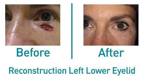 Reconstruction Lower Left Eyelid Before and After