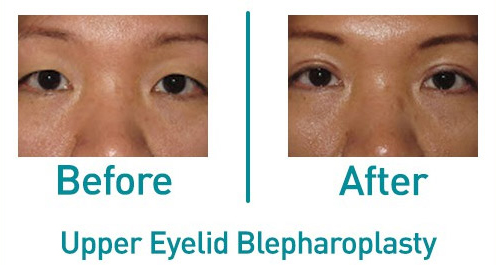 Upper Eyelid Blepharoplasty Before and After